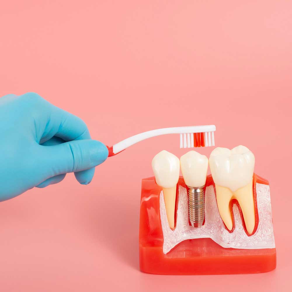 All-on-4 Dental Implants